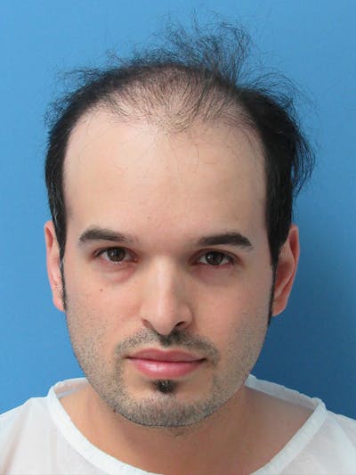 Male Hair Transplant Before & After Gallery - Patient 284912 - Image 1