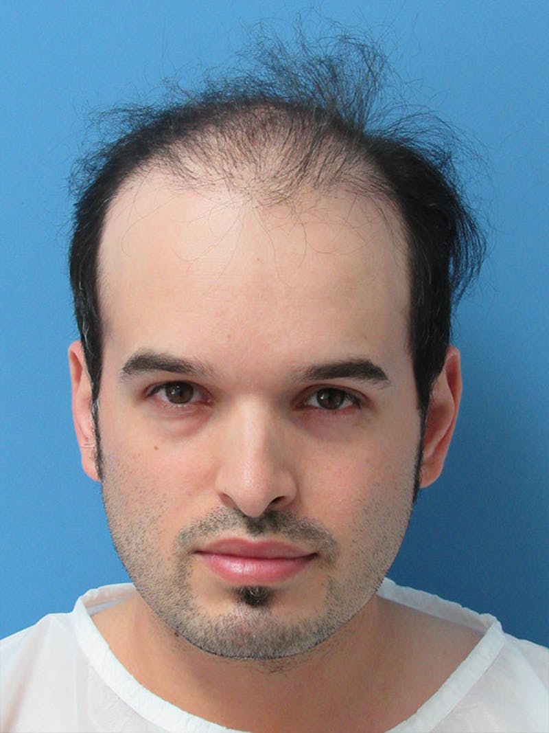 Male Hair Transplant Before & After Gallery - Patient 284912 - Image 1