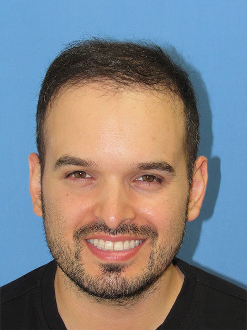 Male Hair Transplant Before & After Gallery - Patient 284912 - Image 2