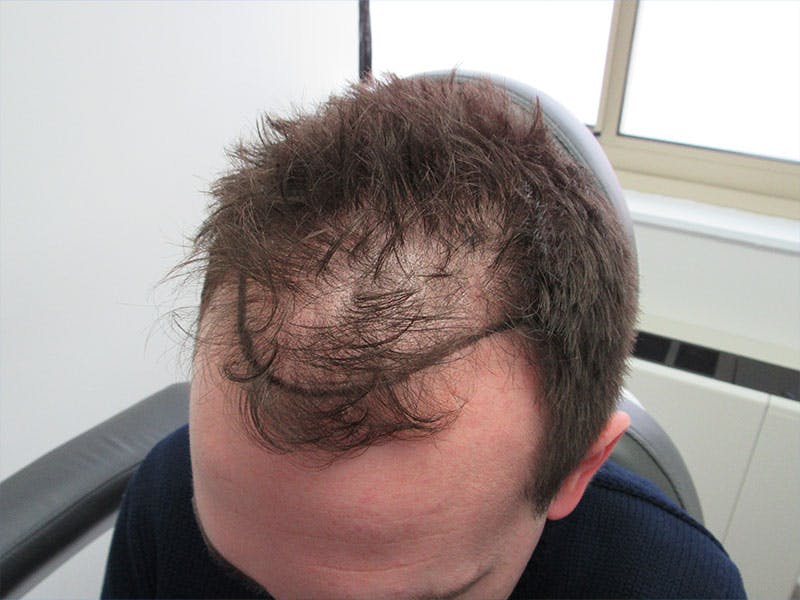 hair restoration patient
