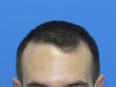 Male Hair Transplant Before & After Gallery - Patient 383521 - Image 2