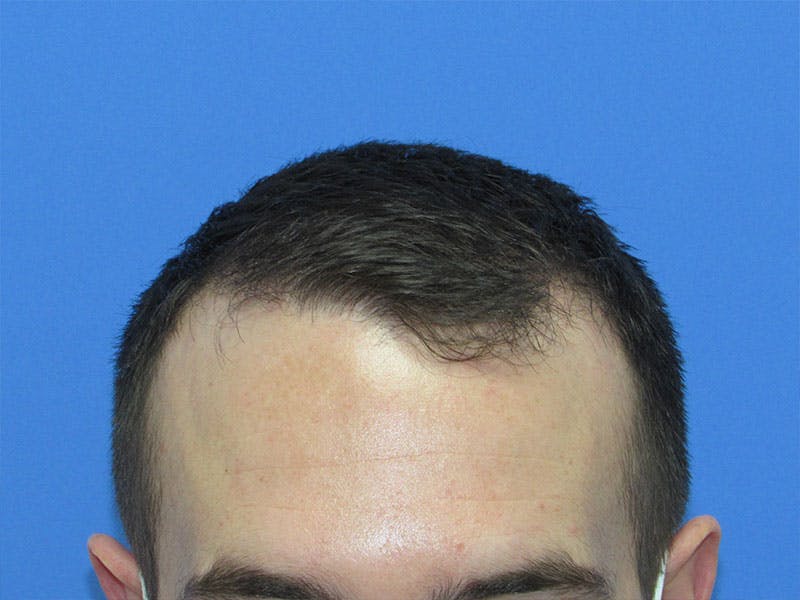 Male Hair Transplant Before & After Gallery - Patient 383521 - Image 2