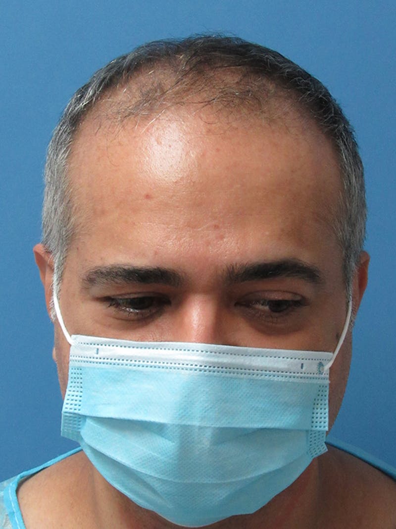 Male Hair Transplant Before & After Gallery - Patient 527403 - Image 1