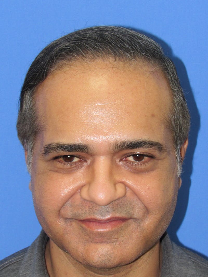 Male Hair Transplant Before & After Gallery - Patient 527403 - Image 2