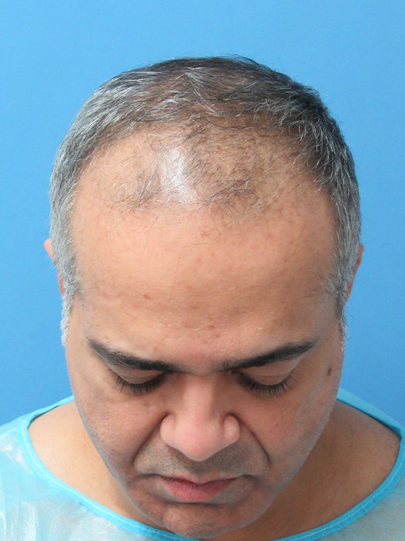 Male Hair Transplant Before & After Gallery - Patient 527403 - Image 3