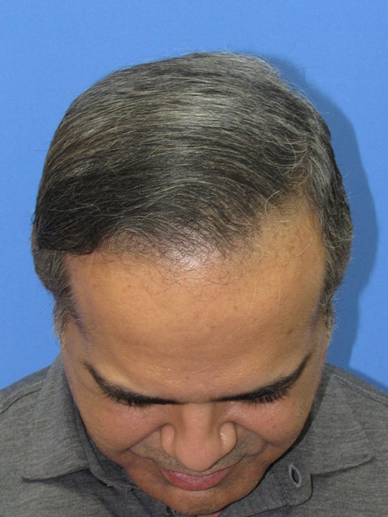 Male Hair Transplant Before & After Gallery - Patient 527403 - Image 4