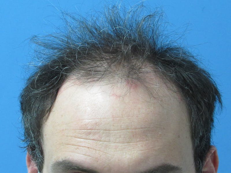 Male Hair Transplant Before & After Gallery - Patient 168197 - Image 1