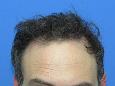 Male Hair Transplant Before & After Gallery - Patient 168197 - Image 2