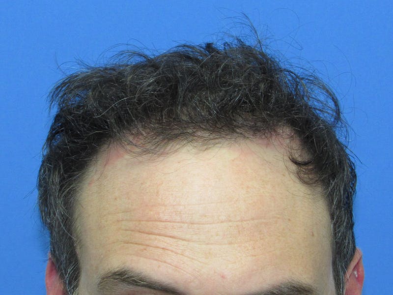 Male Hair Transplant Before & After Gallery - Patient 168197 - Image 2