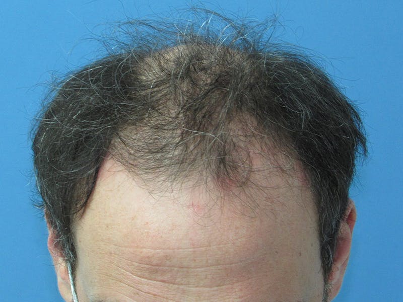 Male Hair Transplant Before & After Gallery - Patient 168197 - Image 3