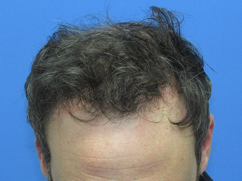Male Hair Transplant Before & After Gallery - Patient 168197 - Image 4