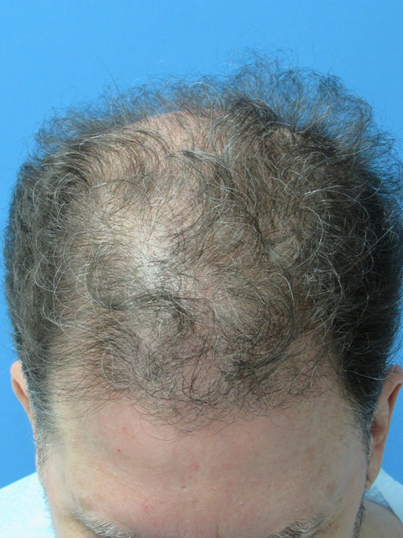 Male Hair Transplant Before & After Gallery - Patient 197598 - Image 1