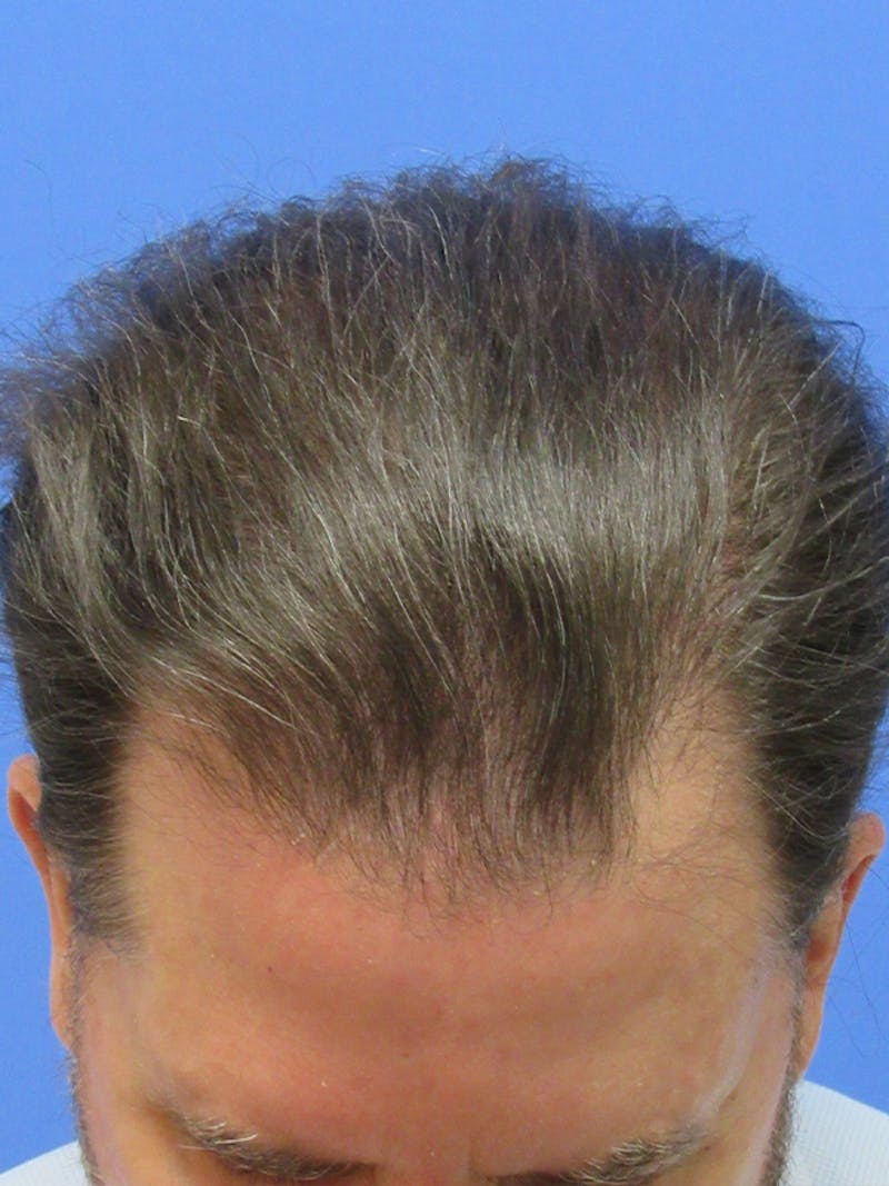Male Hair Transplant Before & After Gallery - Patient 197598 - Image 2