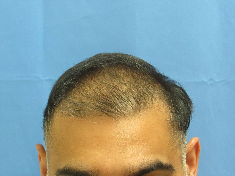 Male Hair Transplant Before & After Gallery - Patient 670453 - Image 1