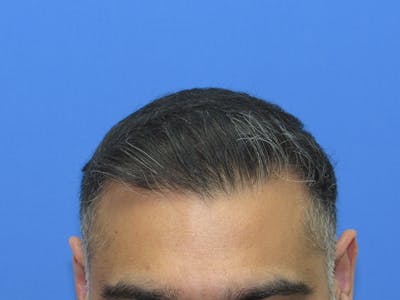 Male Hair Transplant Before & After Gallery - Patient 670453 - Image 2