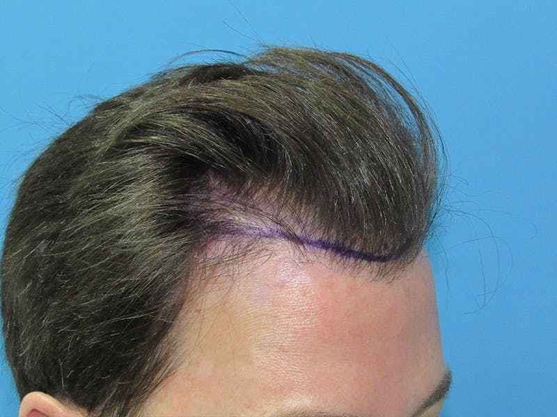 Male Hair Transplant Before & After Gallery - Patient 329073 - Image 1