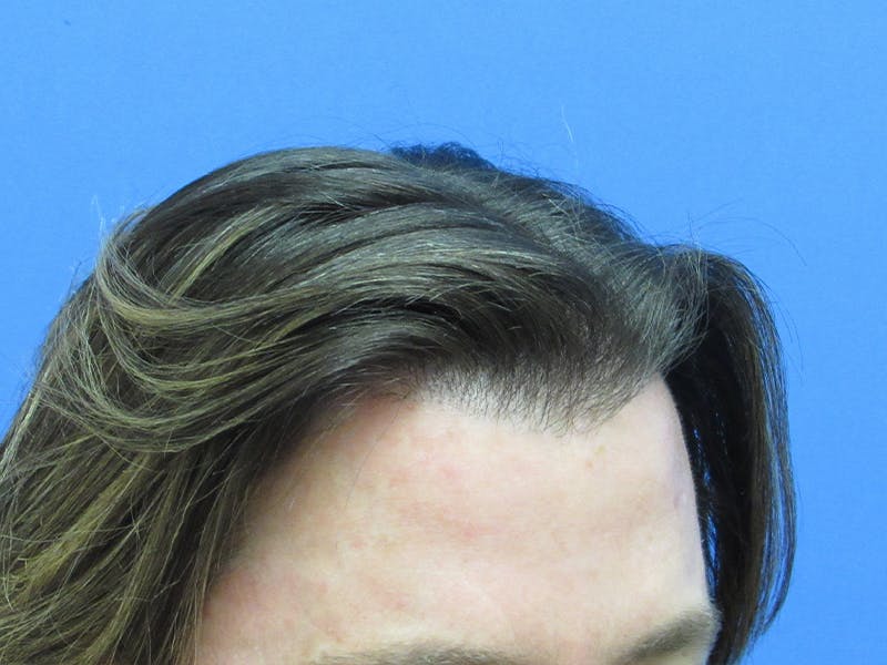 Male Hair Transplant Before & After Gallery - Patient 329073 - Image 2