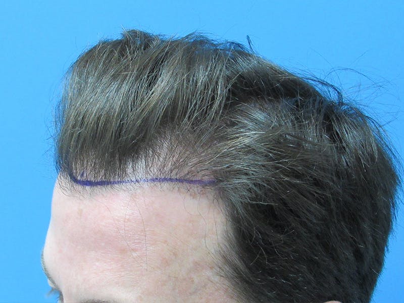 Male Hair Transplant Before & After Gallery - Patient 329073 - Image 3