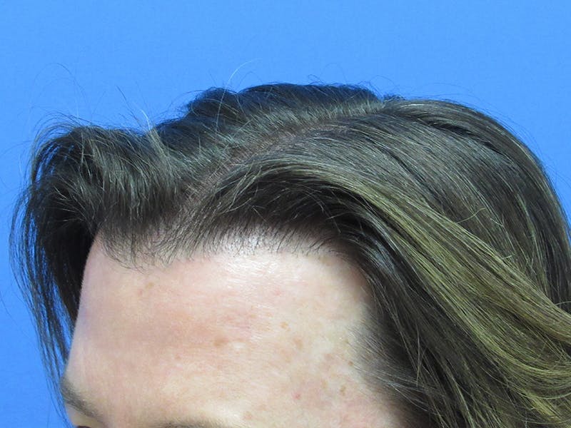 Male Hair Transplant Before & After Gallery - Patient 329073 - Image 4