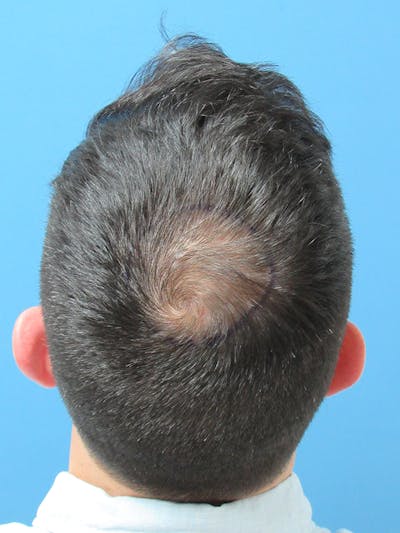 LP Hair Transplant Before & After Gallery - Patient 198243 - Image 1