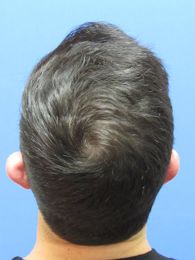 LP Hair Transplant Before & After Gallery - Patient 198243 - Image 2