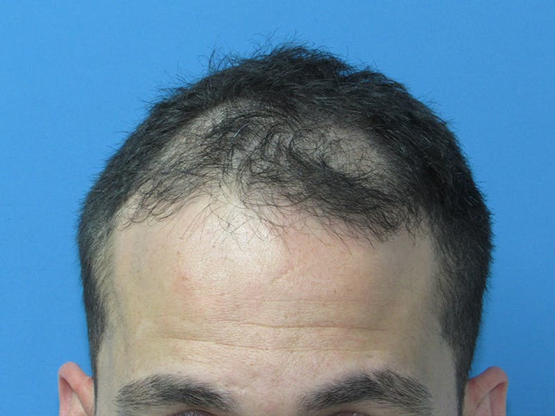 Male Hair Transplant Before & After Gallery - Patient 280036 - Image 1