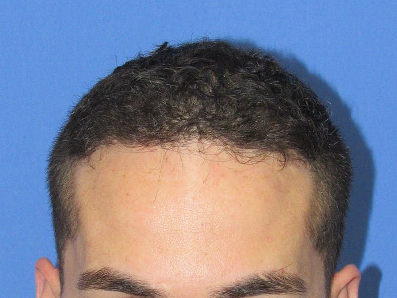 Male Hair Transplant Before & After Gallery - Patient 280036 - Image 2