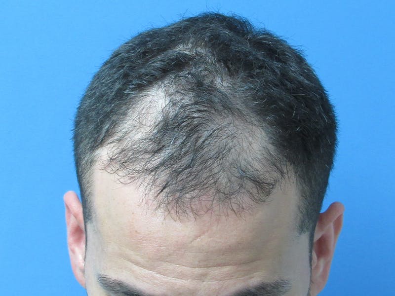 Male Hair Transplant Before & After Gallery - Patient 280036 - Image 3