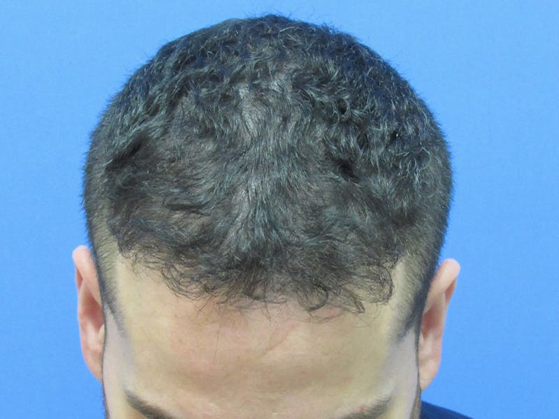 Male Hair Transplant Before & After Gallery - Patient 280036 - Image 4