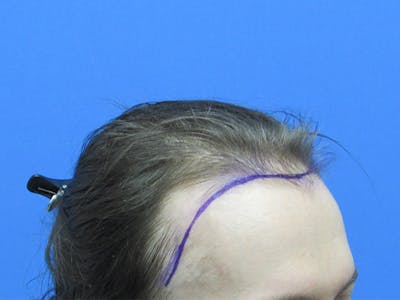Transgender Hair Transplant Before & After Gallery - Patient 396568 - Image 1