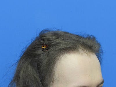 Transgender Hair Transplant Before & After Gallery - Patient 396568 - Image 2