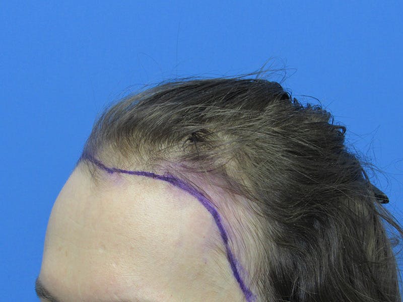 Transgender Hair Transplant Before & After Gallery - Patient 396568 - Image 3