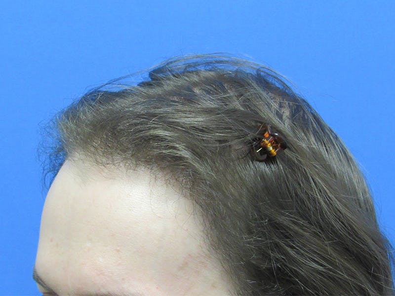 Transgender Hair Transplant Before & After Gallery - Patient 396568 - Image 4