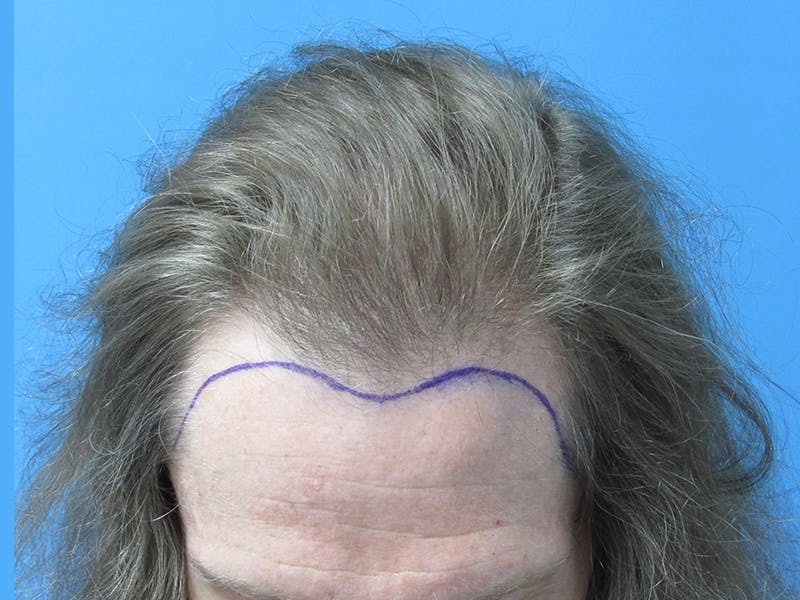hair restoration patient