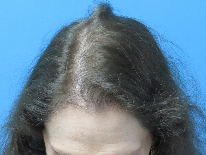 hair restoration patient