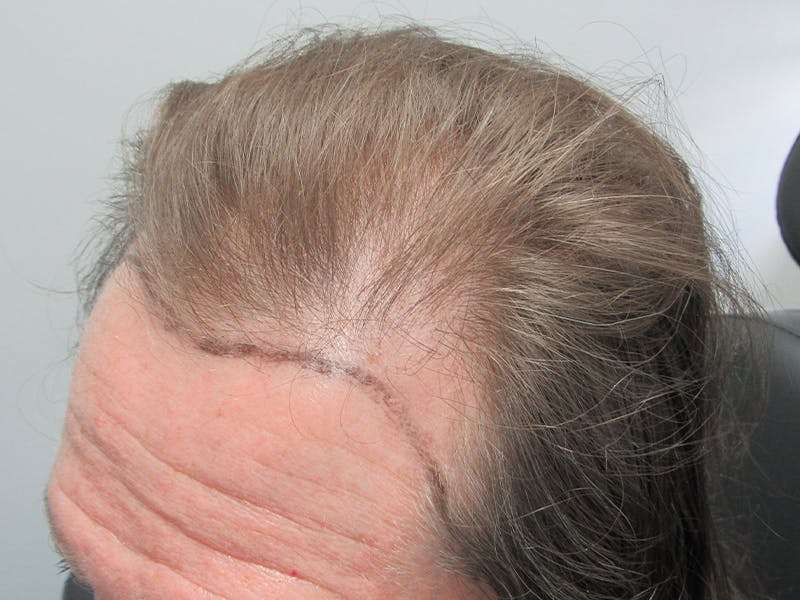 Transgender Hair Transplant Before & After Gallery - Patient 368571 - Image 3