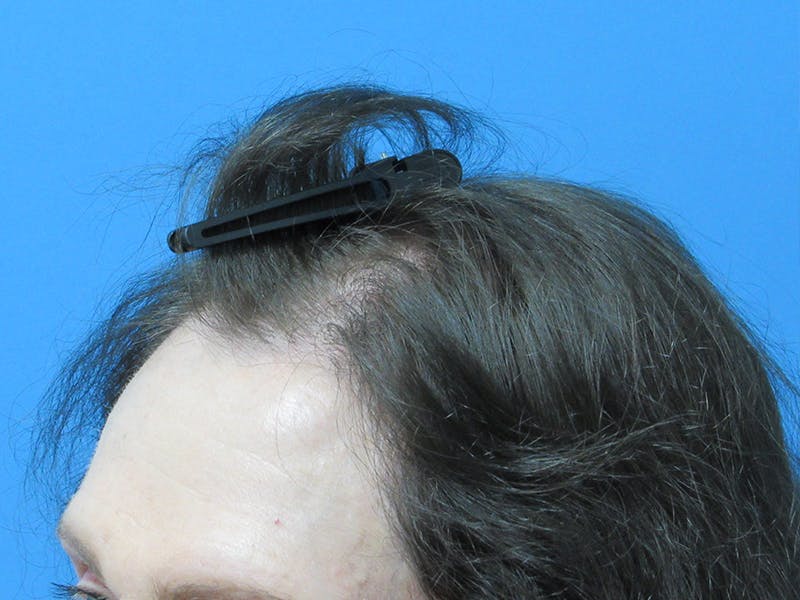 Transgender Hair Transplant Before & After Gallery - Patient 368571 - Image 4