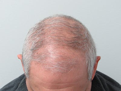 PRP Hair Restoration Before & After Gallery - Patient 334446 - Image 1
