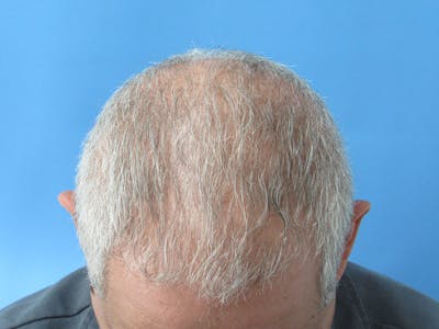 PRP Hair Restoration Before & After Gallery - Patient 334446 - Image 2