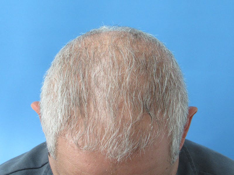 PRP Hair Restoration Before & After Gallery - Patient 334446 - Image 2