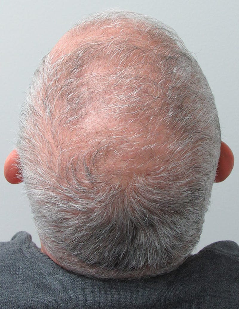 PRP Hair Restoration Before & After Gallery - Patient 334446 - Image 3