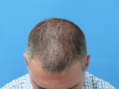 PRP Hair Restoration Before & After Gallery - Patient 997913 - Image 1
