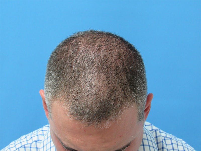 PRP Hair Restoration Before & After Gallery - Patient 997913 - Image 1