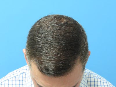 PRP Hair Restoration Before & After Gallery - Patient 997913 - Image 2