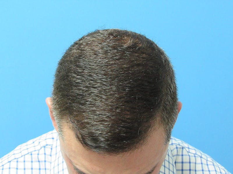 PRP Hair Restoration Before & After Gallery - Patient 997913 - Image 2