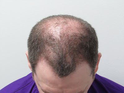 PRP Hair Restoration Before & After Gallery - Patient 382266 - Image 1