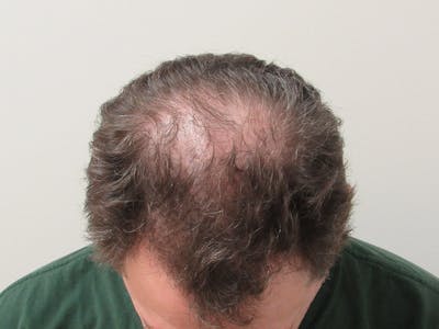 PRP Hair Restoration Before & After Gallery - Patient 382266 - Image 2