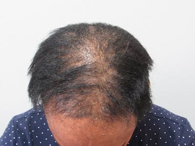PRP Hair Restoration Before & After Gallery - Patient 741573 - Image 1