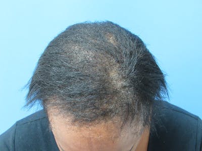 PRP Hair Restoration Before & After Gallery - Patient 741573 - Image 2
