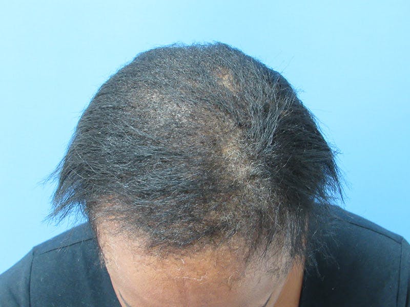 PRP Hair Restoration Before & After Gallery - Patient 741573 - Image 2